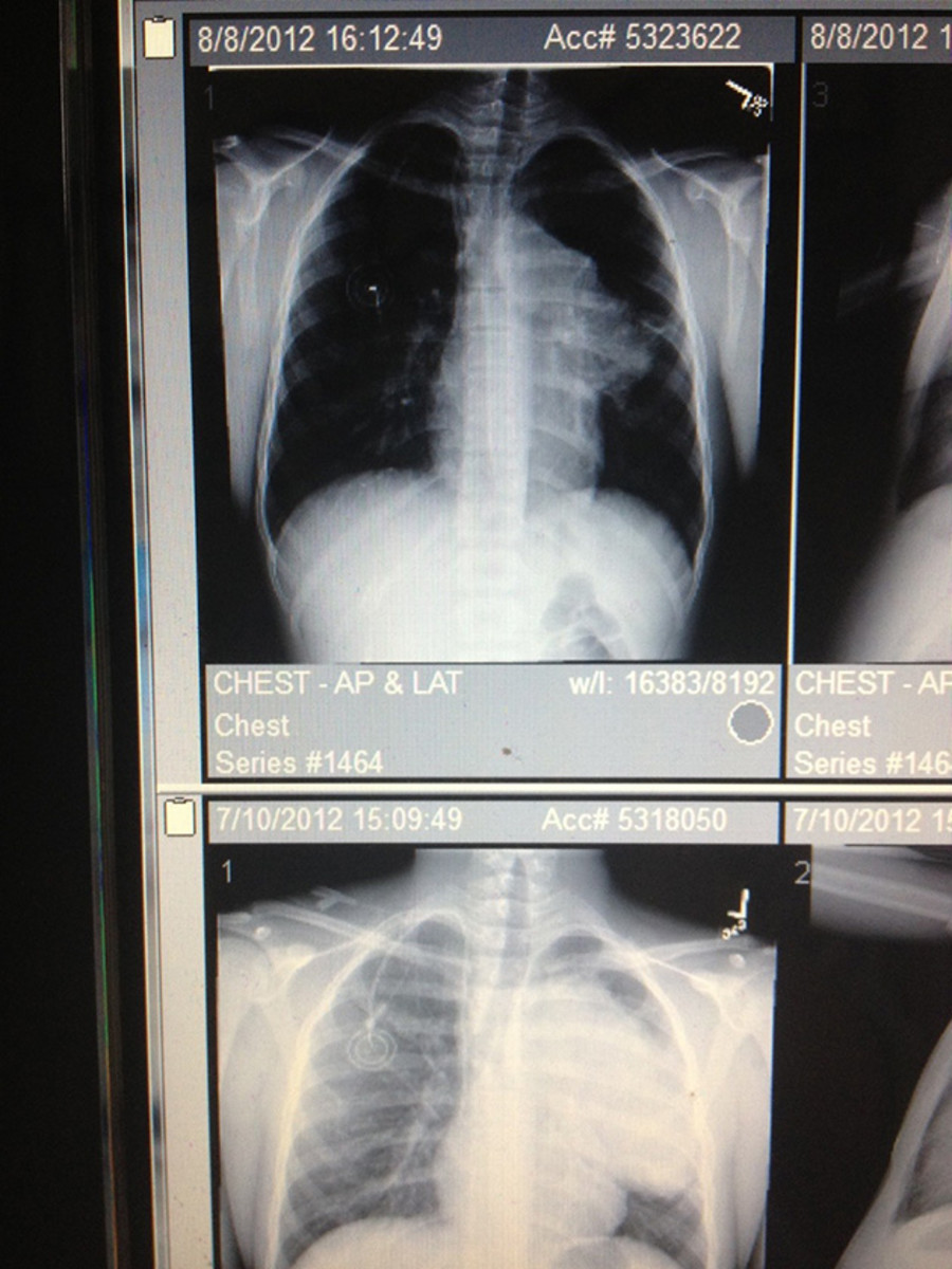 Comparisons of Edler's two MRIs. 